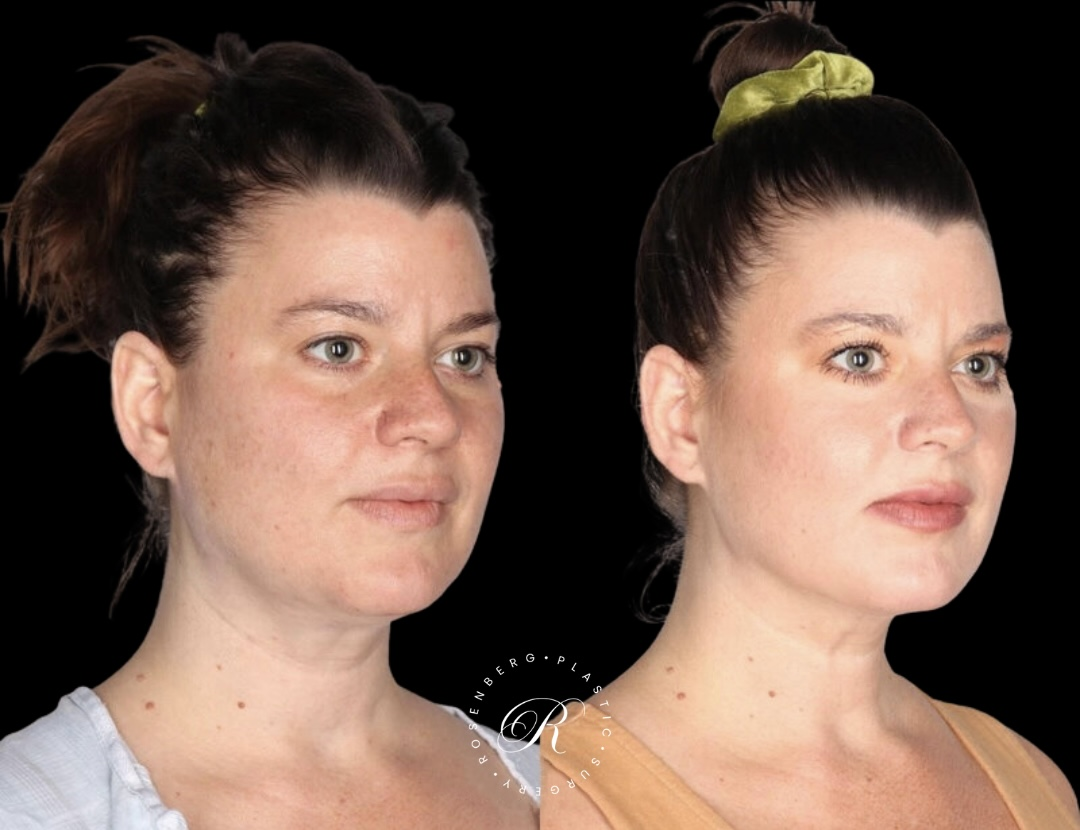 Neck Lipo RPS Before & After.zip - 5