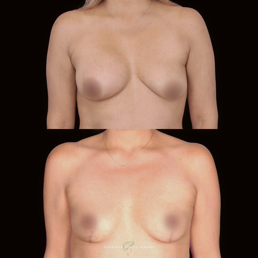 Breast Lift Results