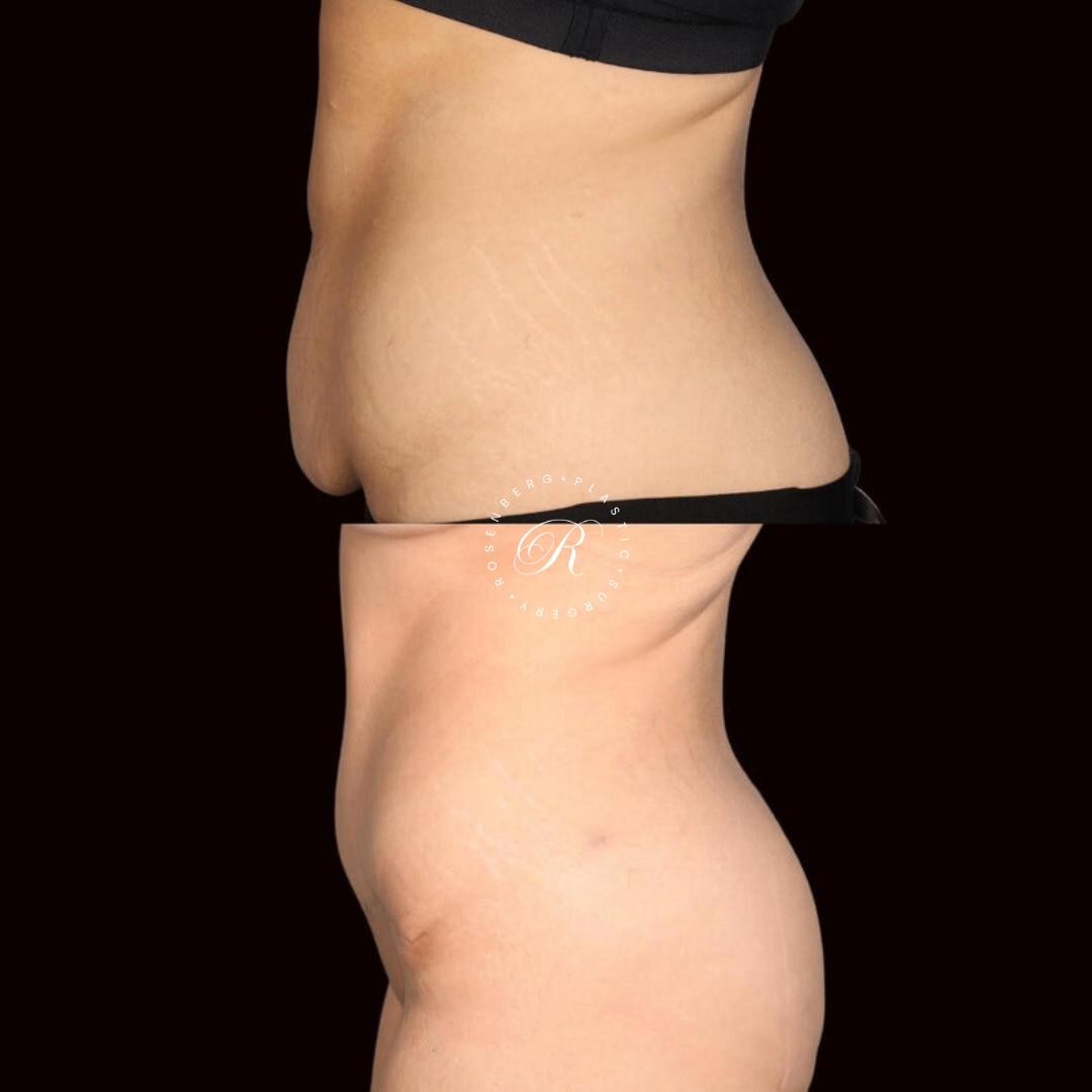 Abdominoplasty RPS Before & After.zip - 2