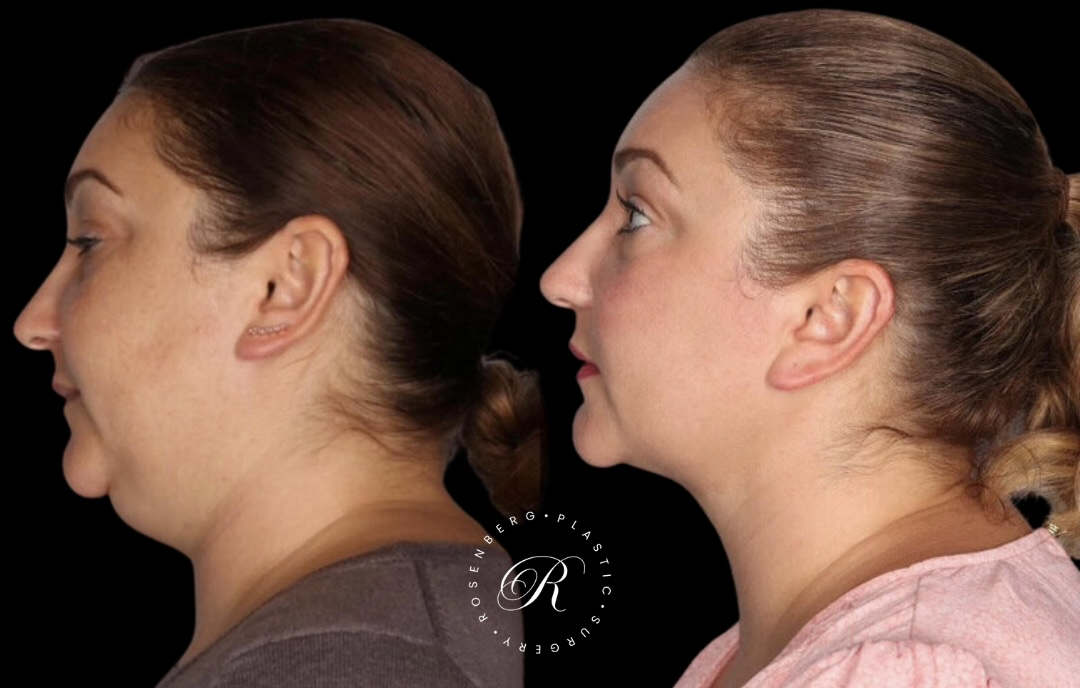Neck Lipo RPS Before & After.zip - 23