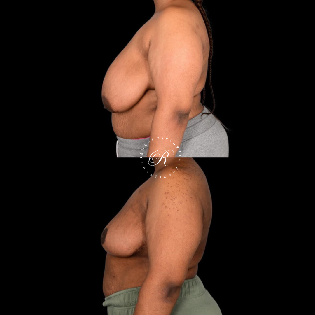 Breast Lift & Reduction RPS Before & Afters.zip - 31