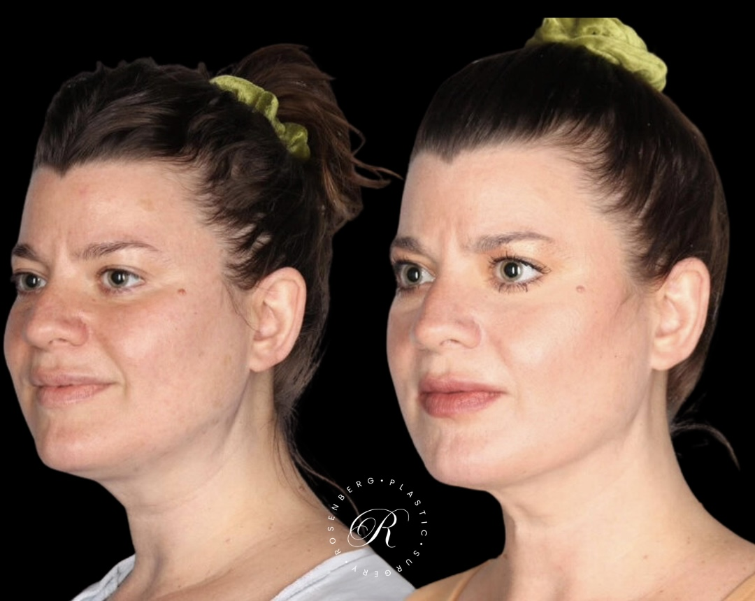 Neck Lipo RPS Before & After.zip - 3