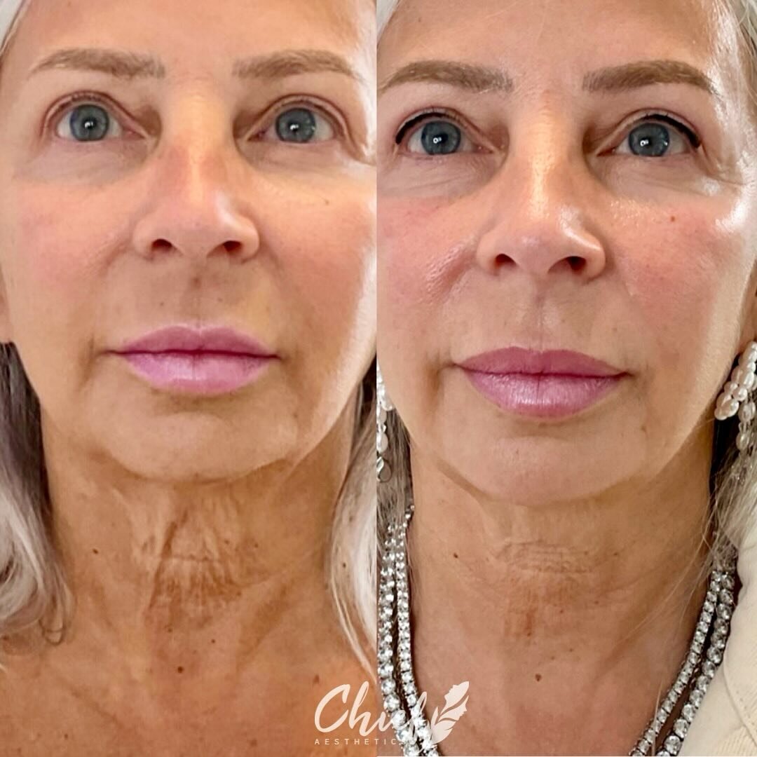 Neck-aesthetic-chief-buffalo-ny