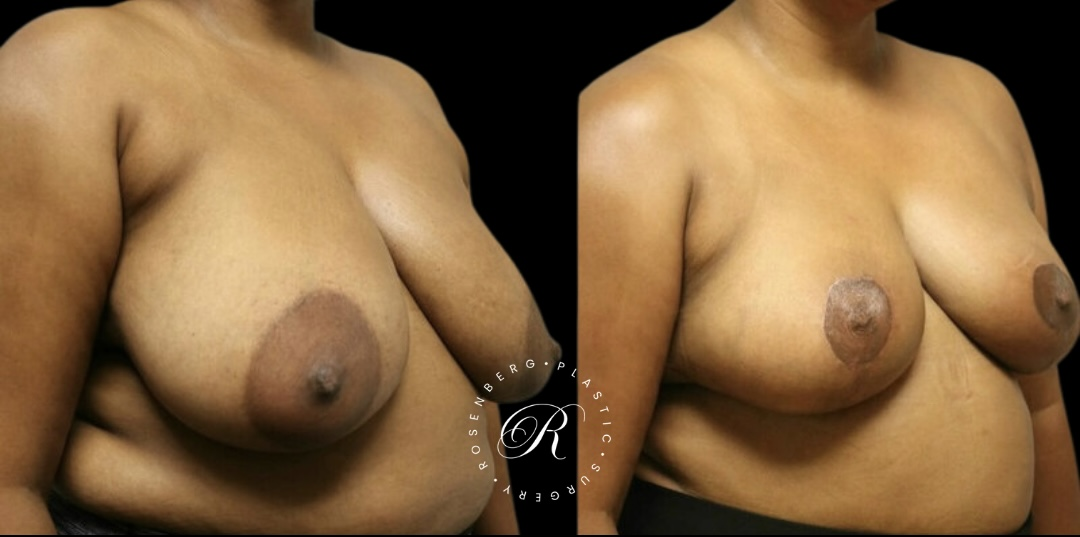 Breast Lift & Reduction RPS Before & Afters.zip - 90