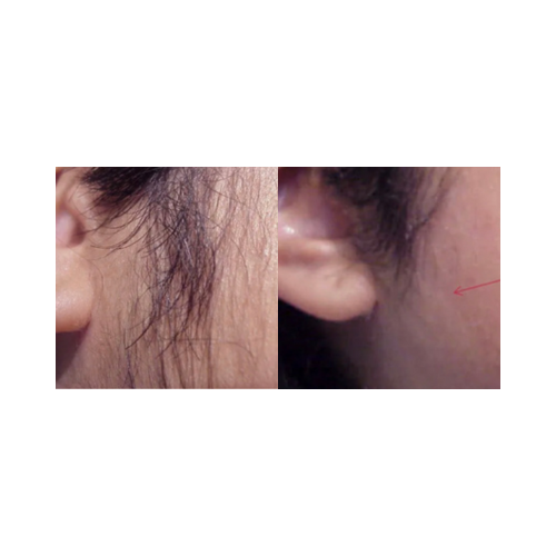 Before and after laser hair removal using Cervello triple wavelength system
