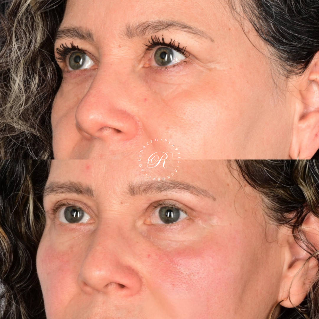 Blepharoplasty RPS Before & After.zip - 2