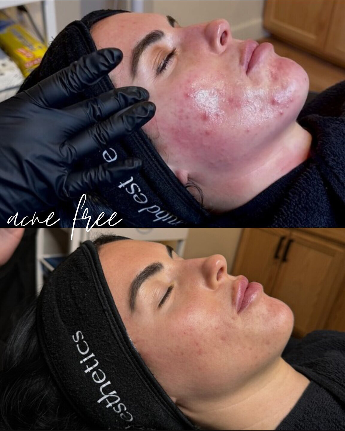pittsburgh-acne-treatment