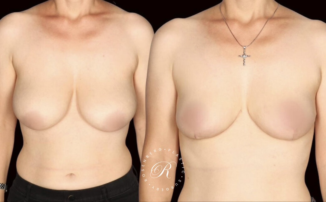 Breast Lift & Reduction RPS Before & Afters.zip - 88