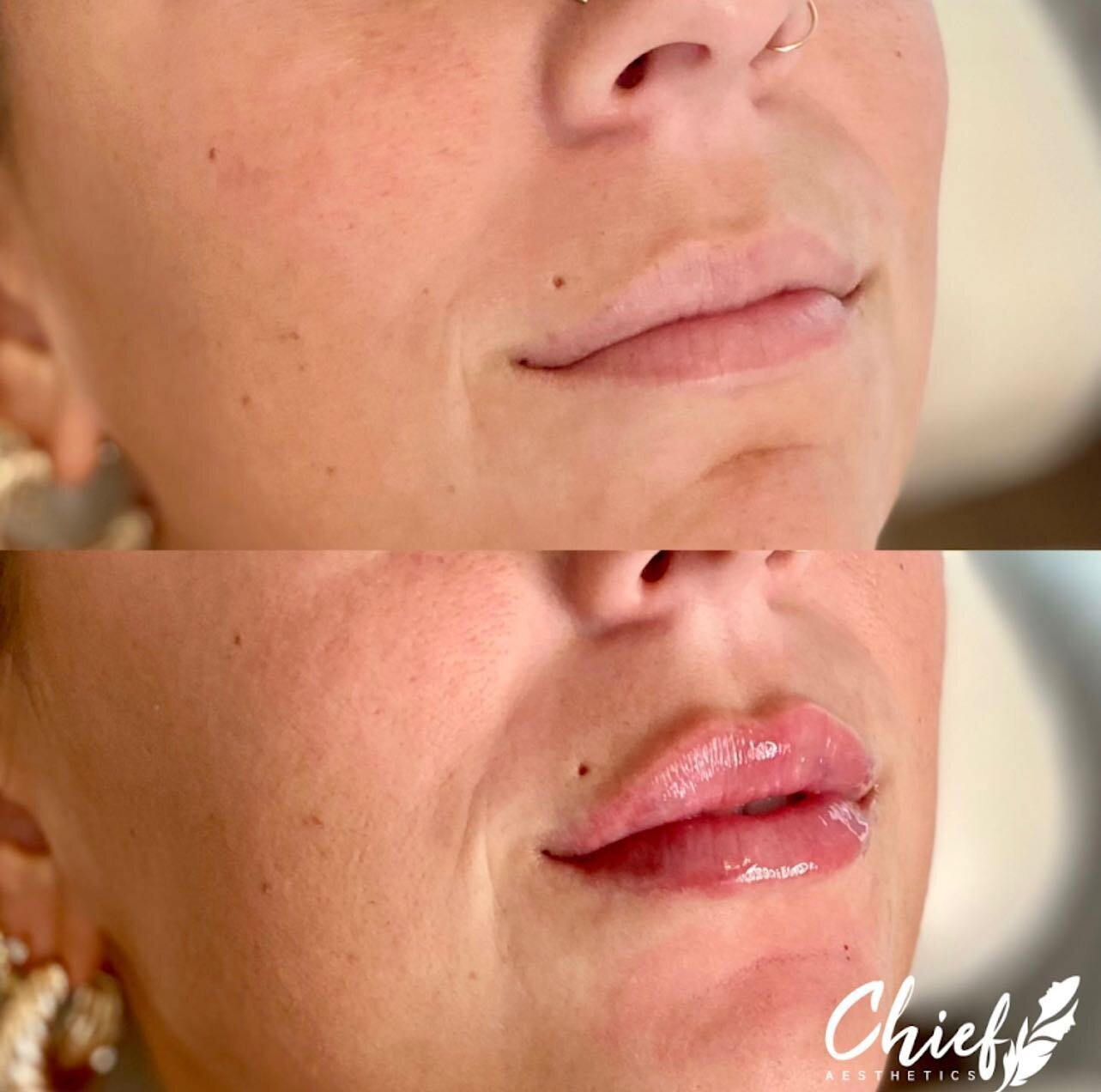 Lip-filler-chief-aesthetics-ny