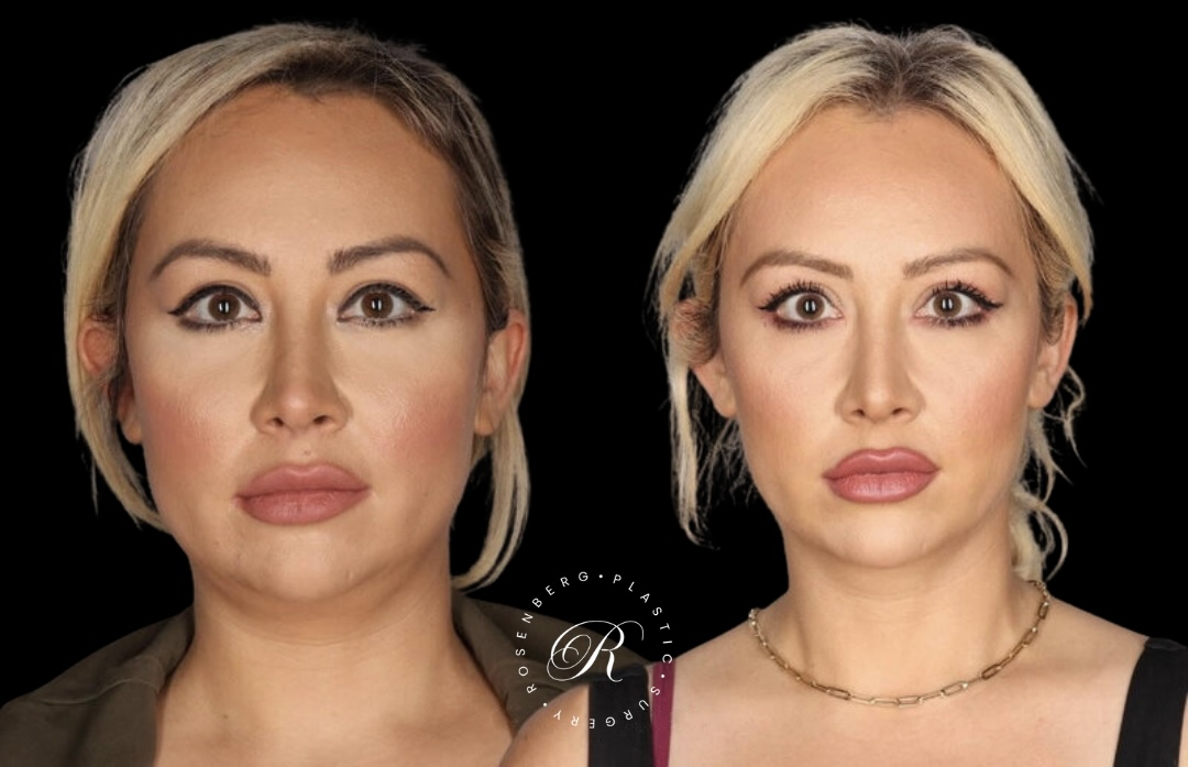 Neck Lipo RPS Before & After.zip - 11