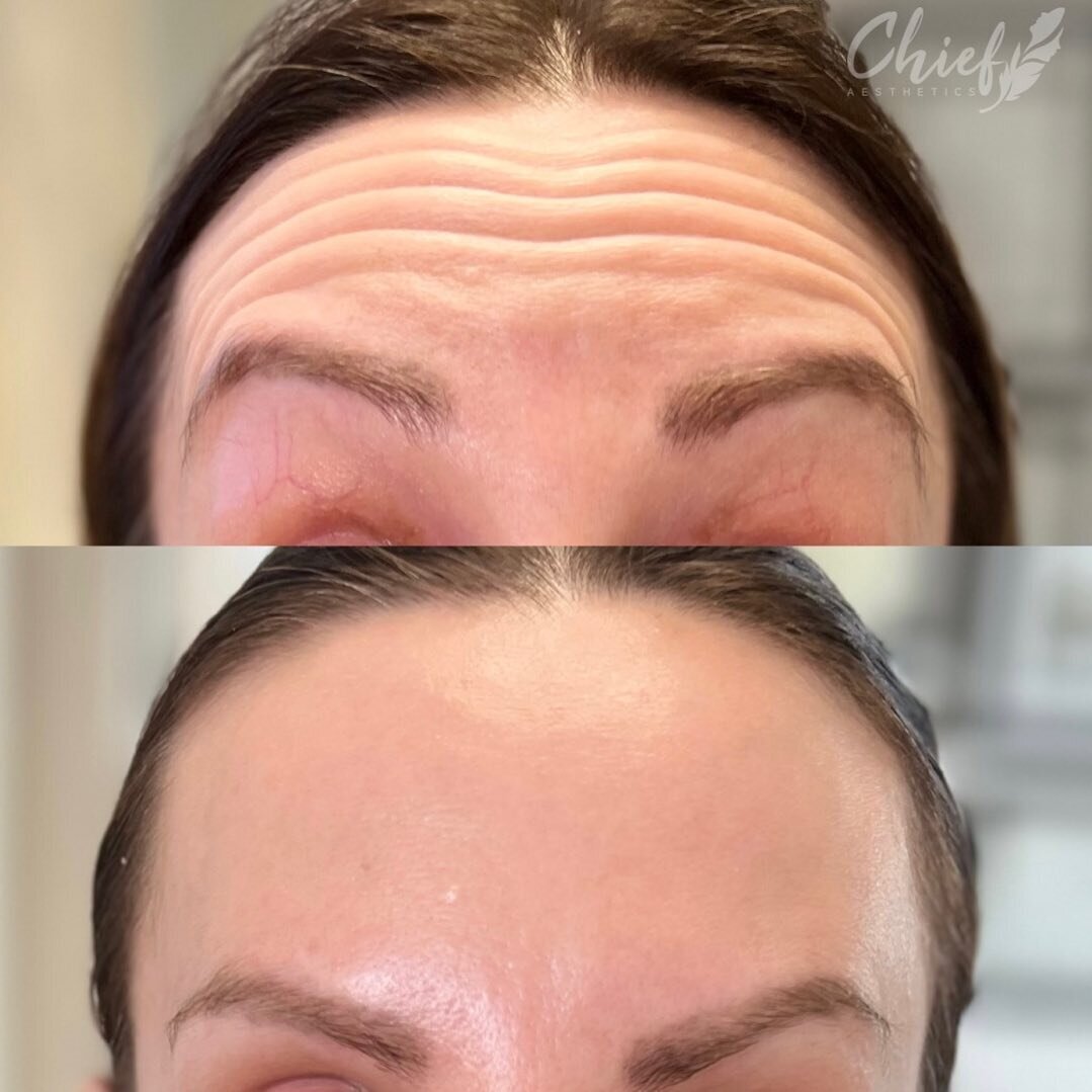 botox-before-after-williamsville-new-york-chief-aesthetics