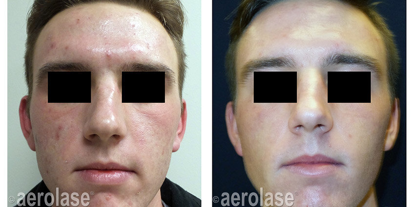 Neo Rejuvenation - After 3 Treatments - Kevin Pinski MD