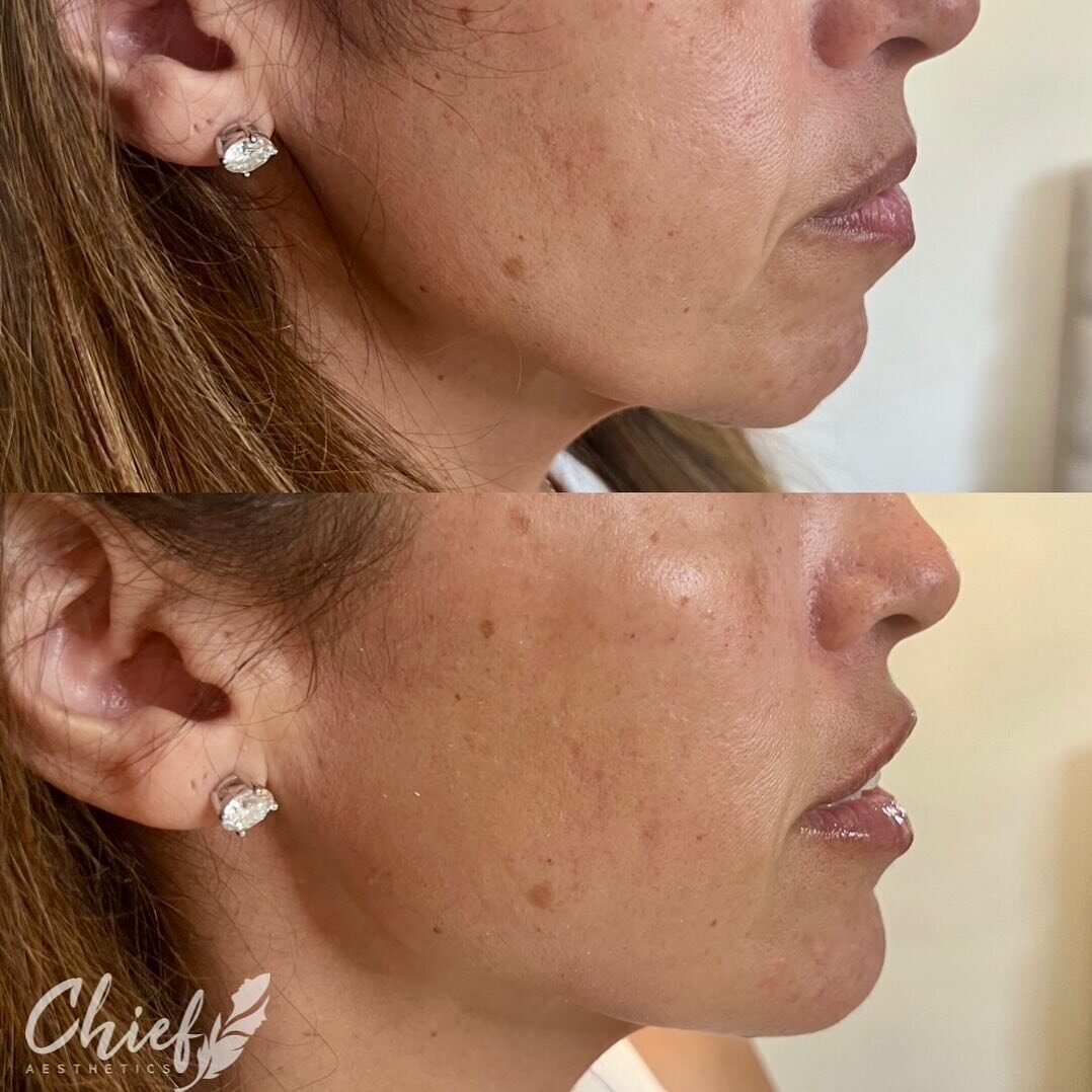 before-and-after-chin-and-cheek-treatment-by-chief-aesthetics-western-new-york