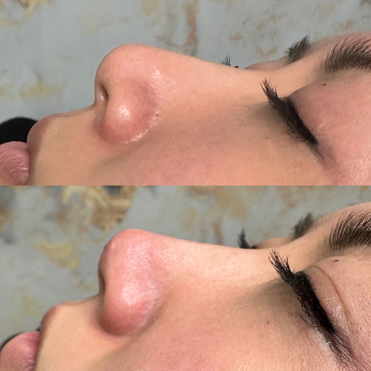 W Aesthetics Non Surgical Rinoplasty  Before and After Austin Texas2