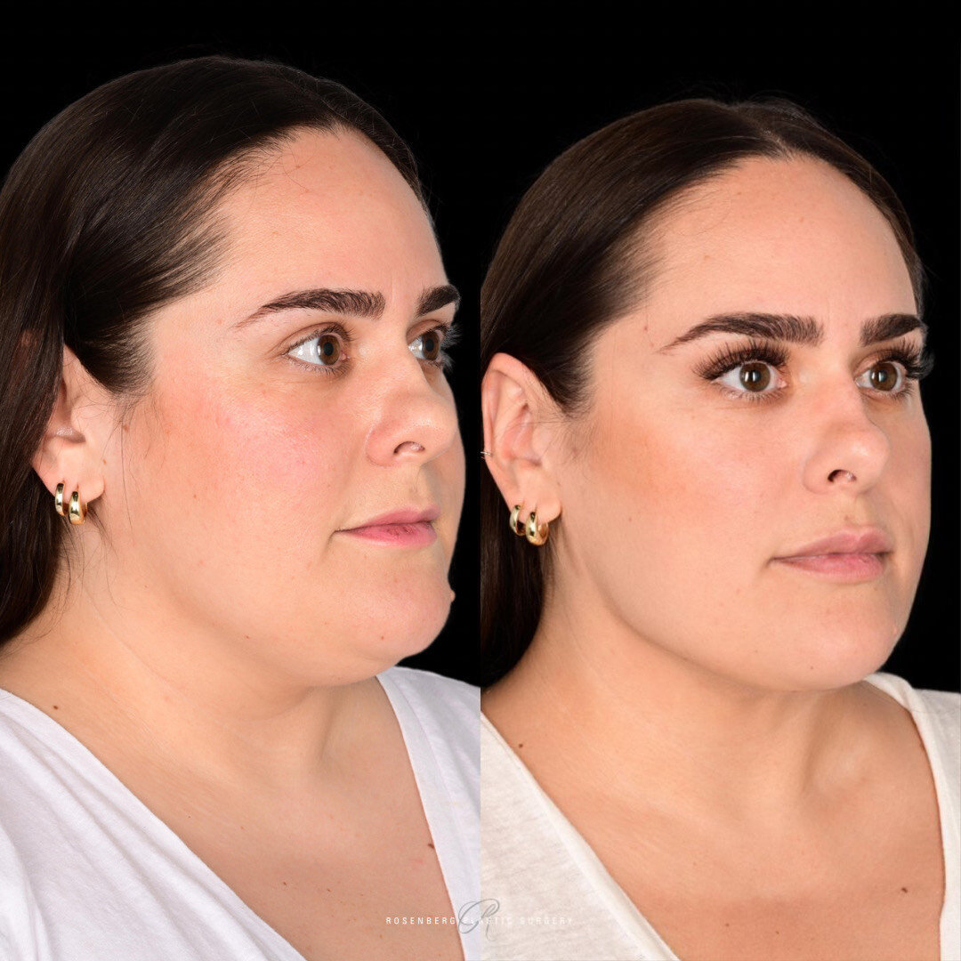 Neck Liposuction Results