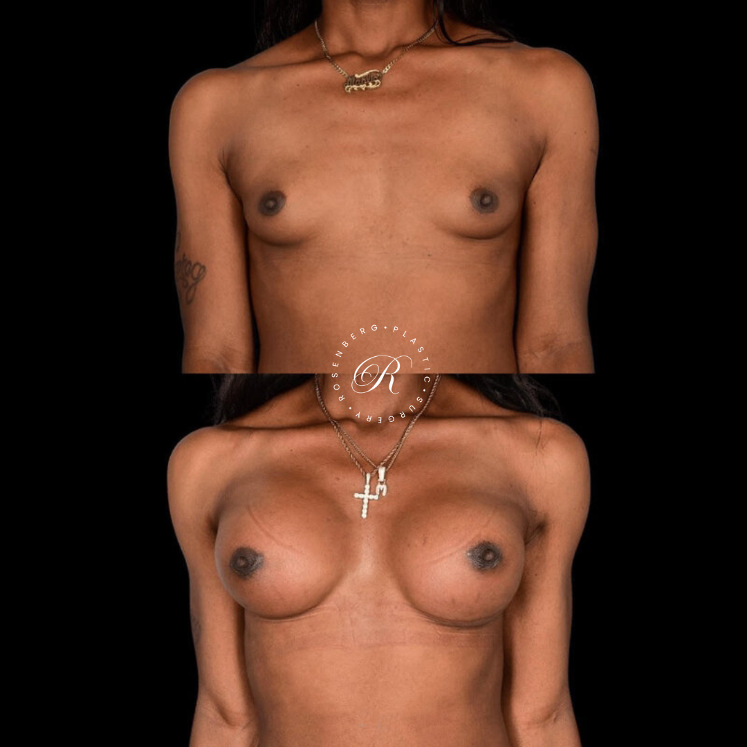 Top Surgery RPS Before & After.zip - 2