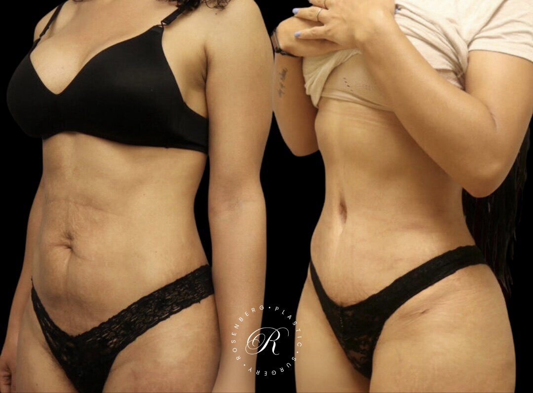 Abdominoplasty RPS Before & After.zip - 6
