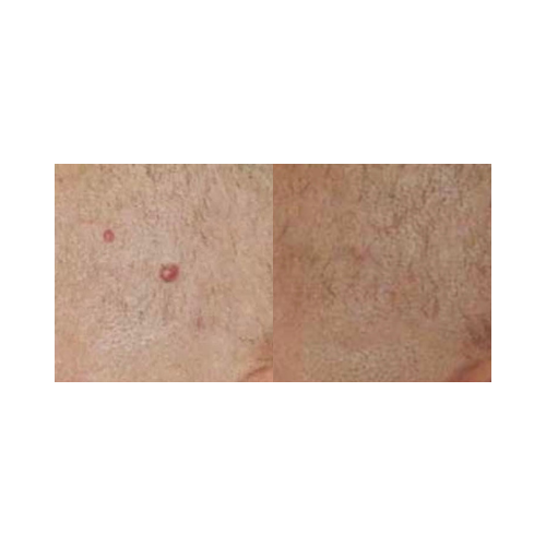 Before and after vascular lesion treatment using DermaLight KTP laser