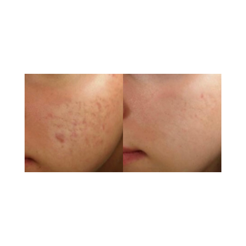 Rosacea and facial redness reduced after KTP laser treatment