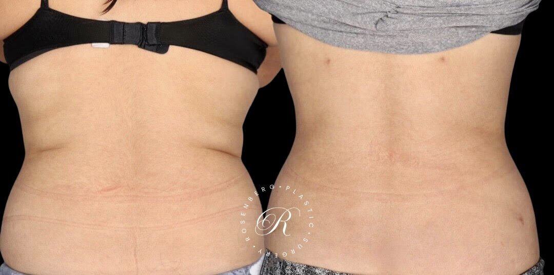 Liposuction of Abs, Back and Flanks RPS Before & After.zip - 3