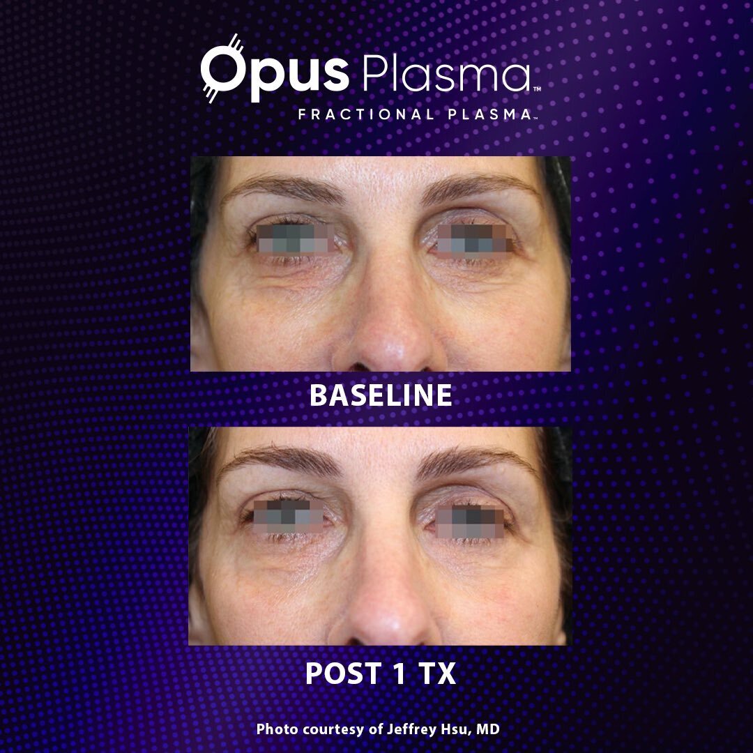 Opus Plasma Results