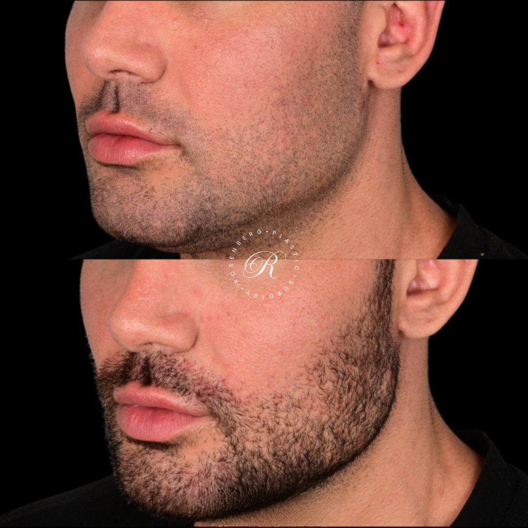 Neck Lipo RPS Before & After.zip - 35
