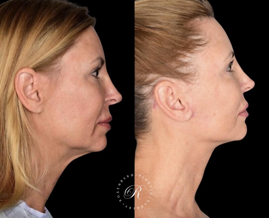Facelift RPS Before & After.zip - 2