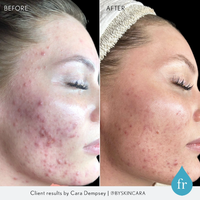 acne-specialist-pittsburgh