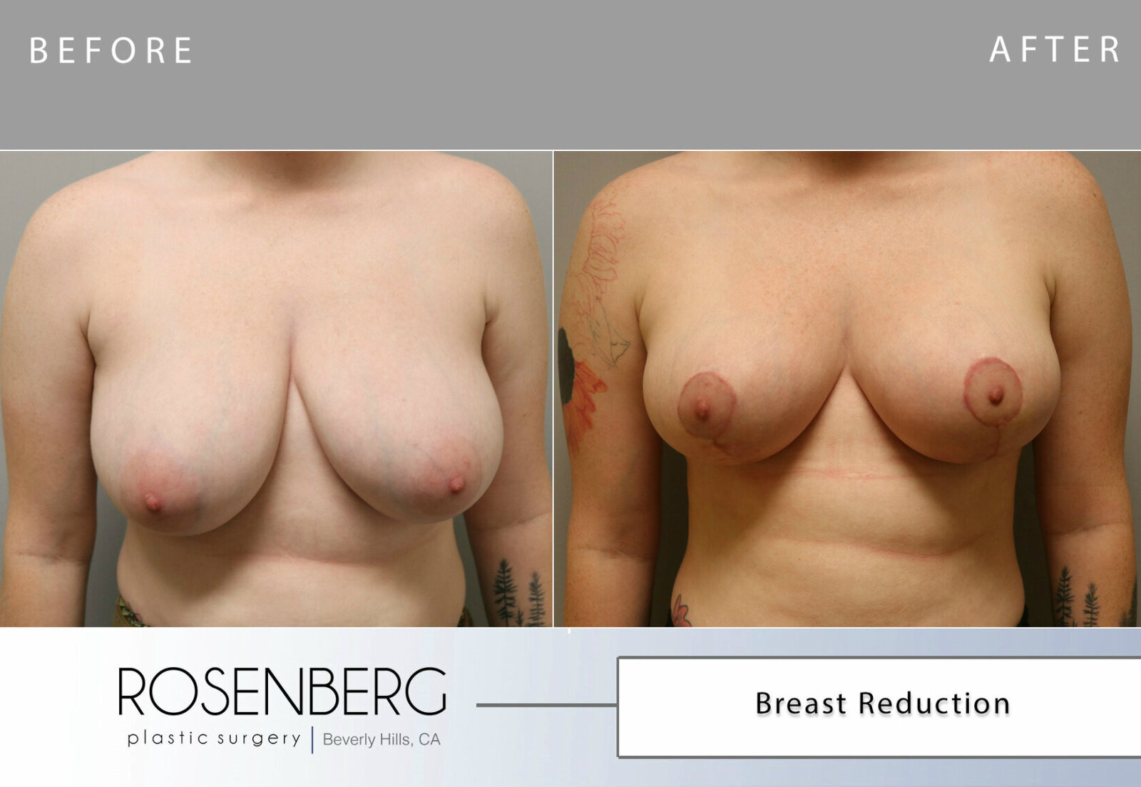 Breast Reduction and Lift Results