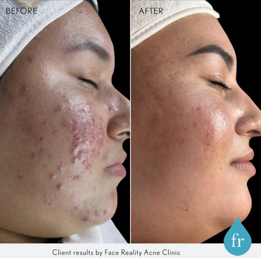 pittsburgh-acne-program
