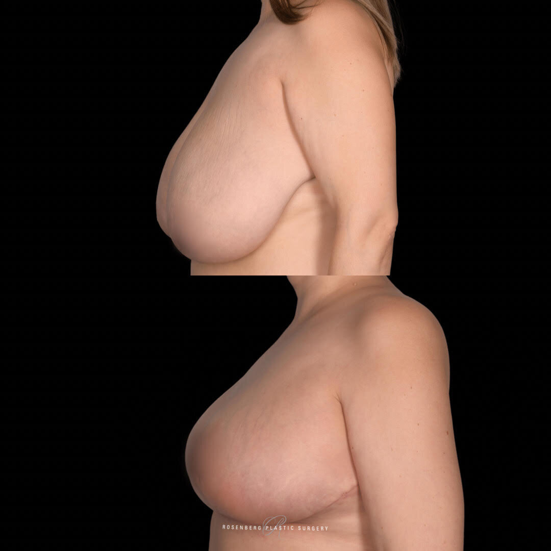 Breast Reduction and Lift Results