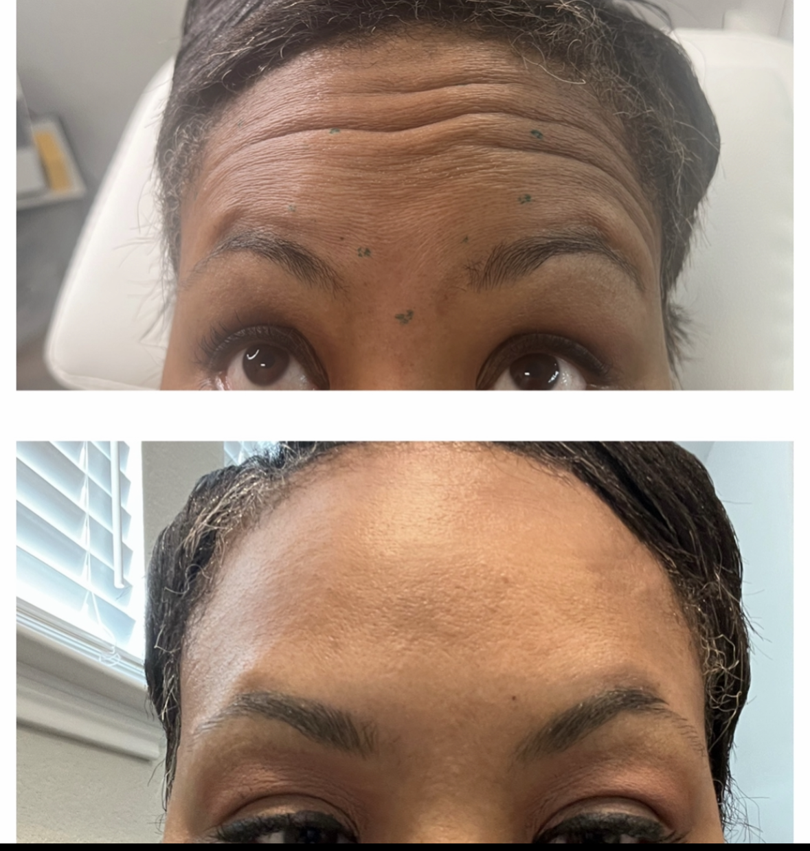 W Aesthetics Botox Before and After. Austin Texas6