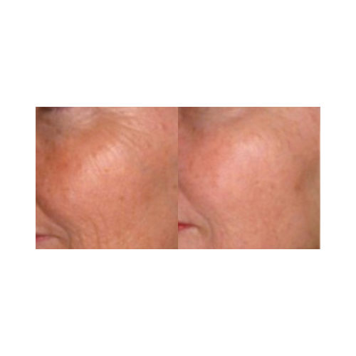 Collagen induction therapy reducing acne scars with DermalPen