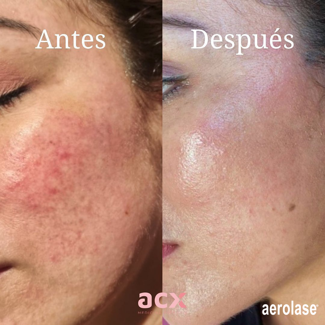 Rosacea Treatments by Aerolase
