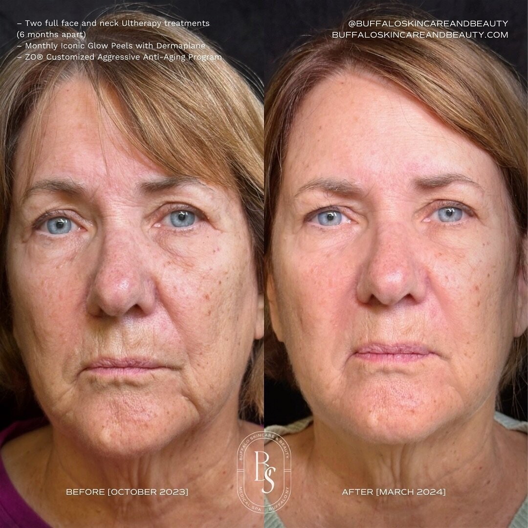 Ultherapy-chief-aesthetic-ny