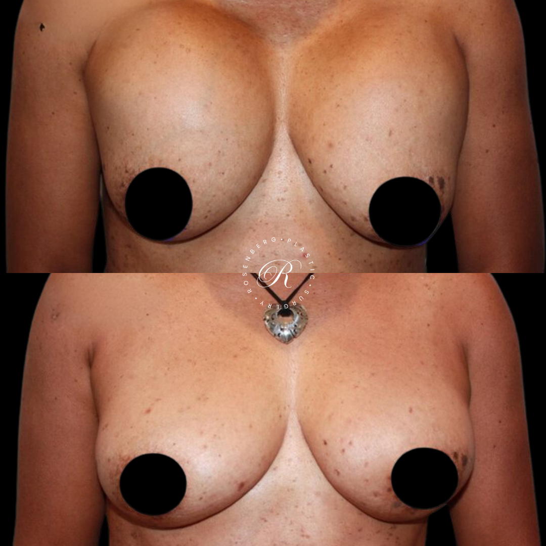 Breast Implant Removal RPS Before & Afters.zip - 4