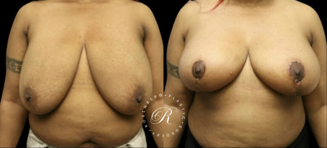 Breast Lift & Reduction RPS Before & Afters.zip - 81