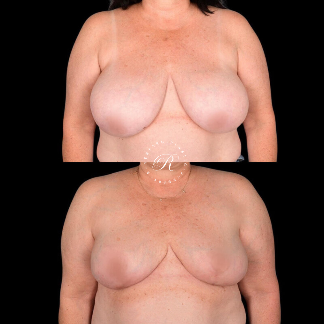 Breast Lift & Reduction RPS Before & Afters.zip - 54