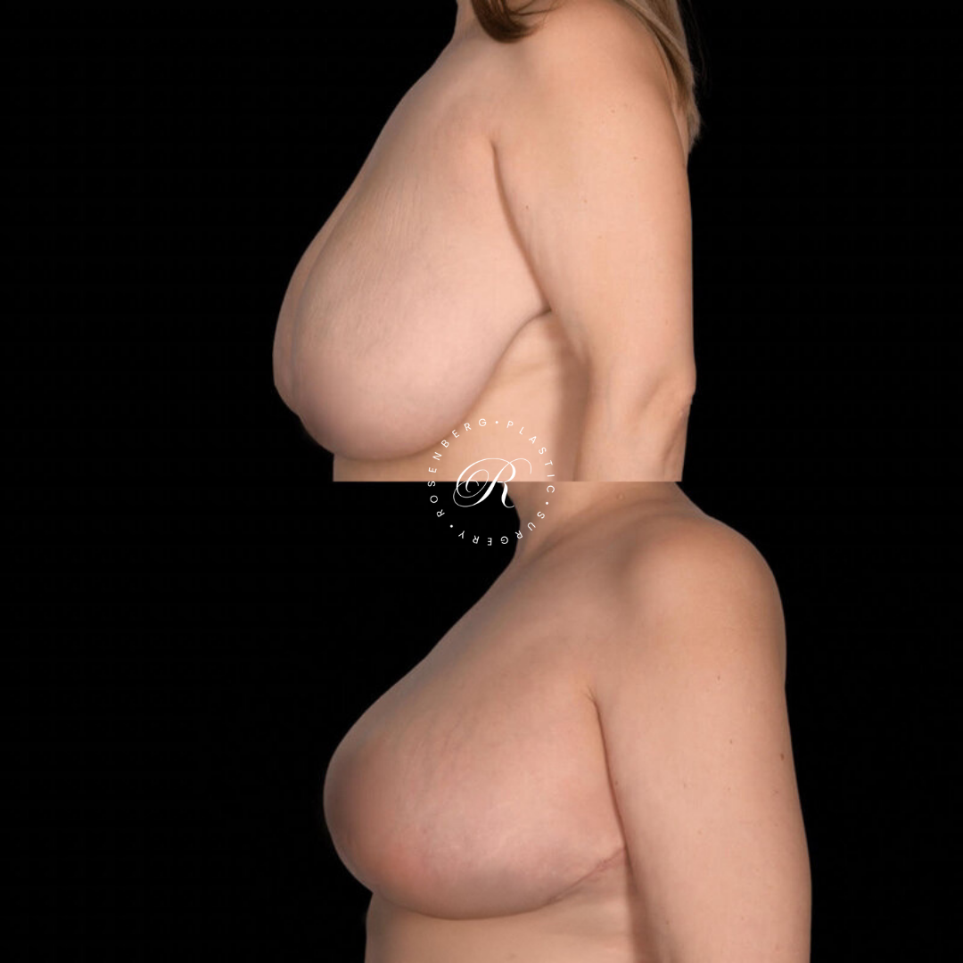 Breast Lift & Reduction RPS Before & Afters.zip - 22