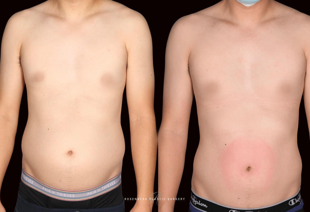 Liposuction Results