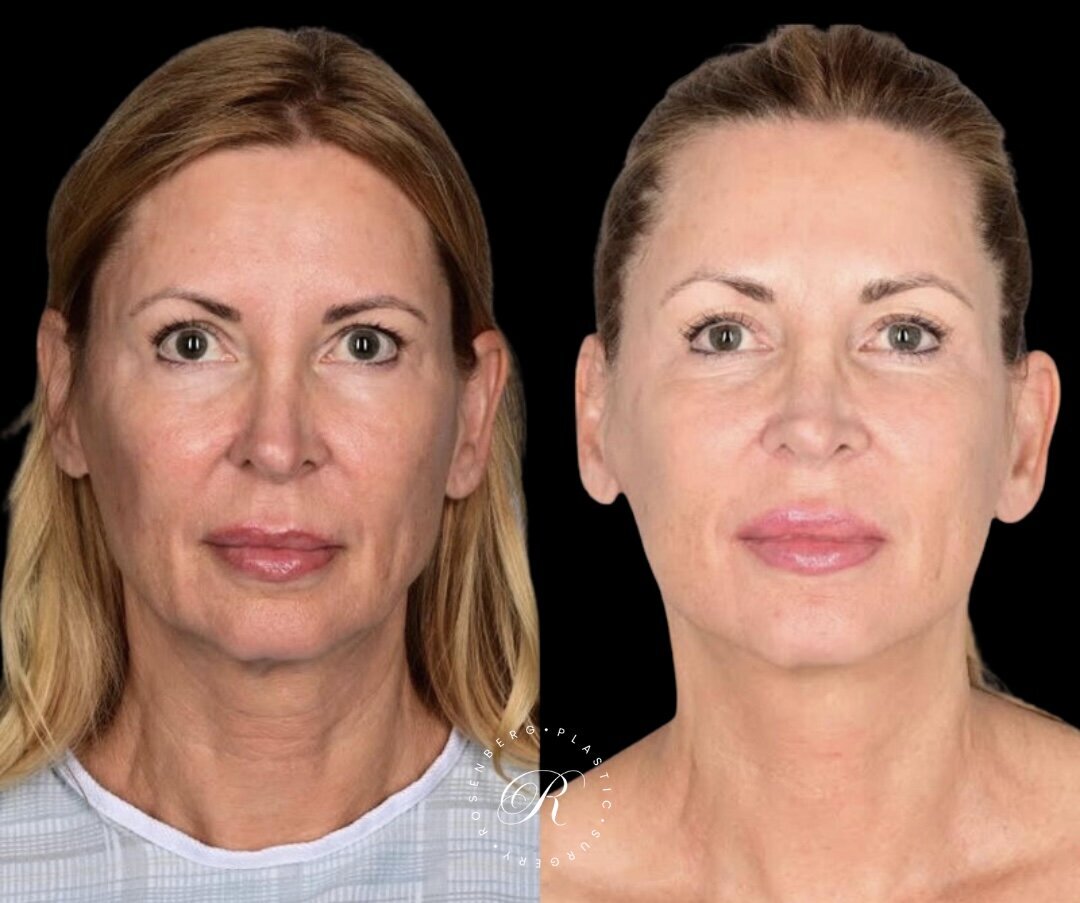 Facelift RPS Before & After.zip - 3