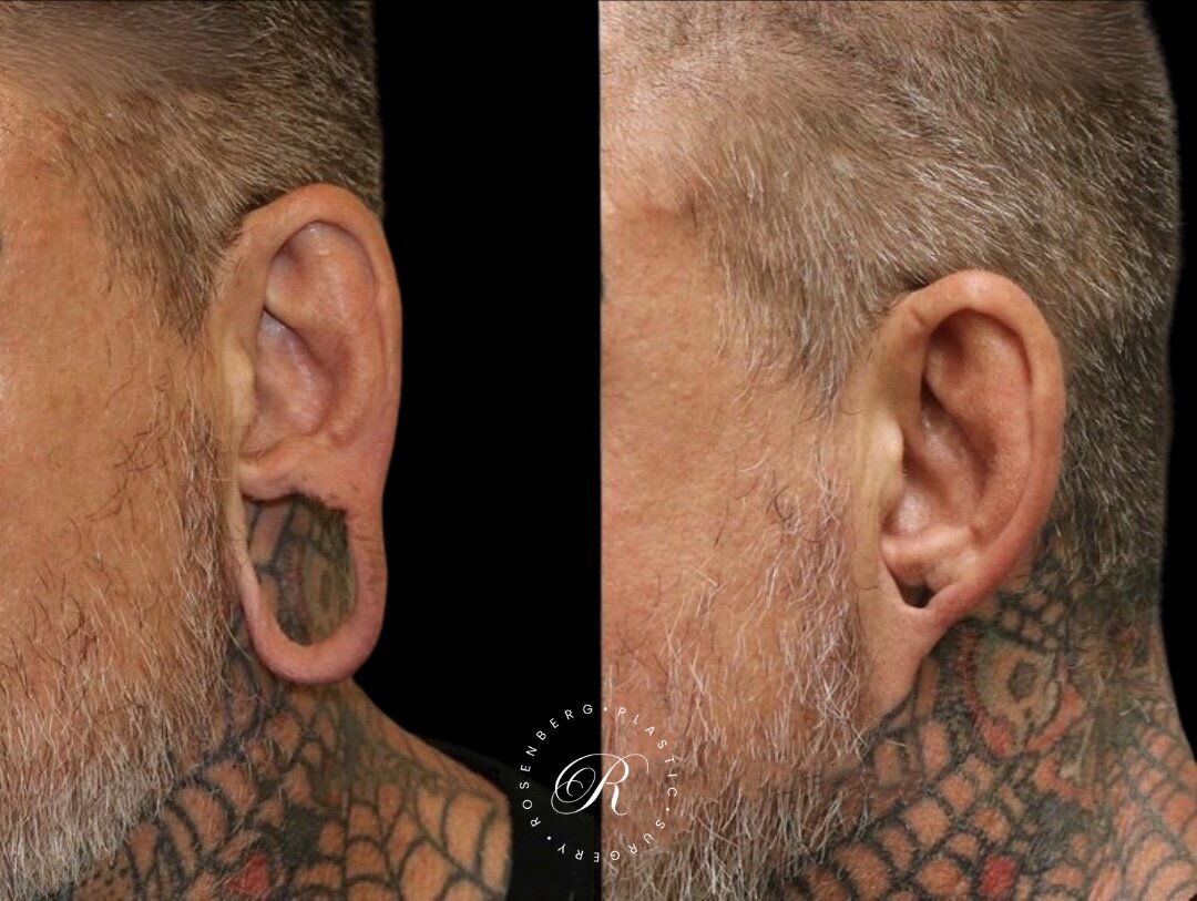 Earlobe Repair RPS Before & After.zip - 1