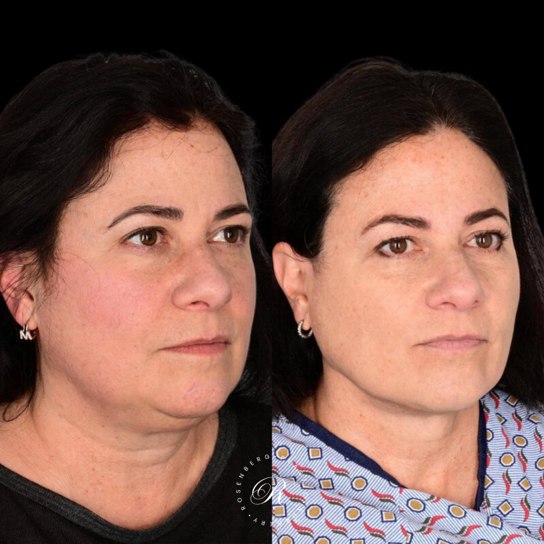 Neck Lipo RPS Before & After.zip - 14