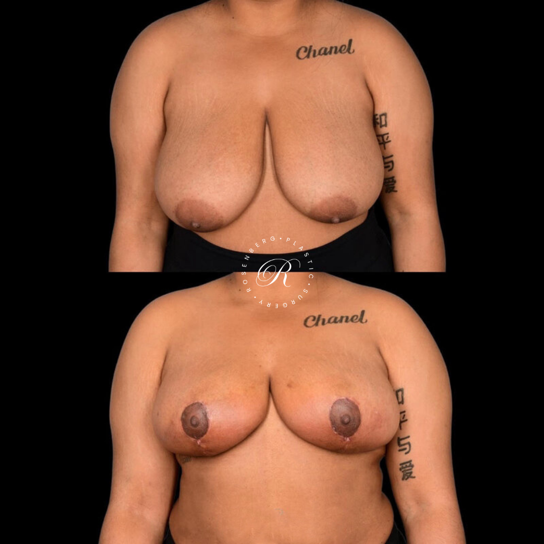 Breast Lift & Reduction RPS Before & Afters.zip - 74