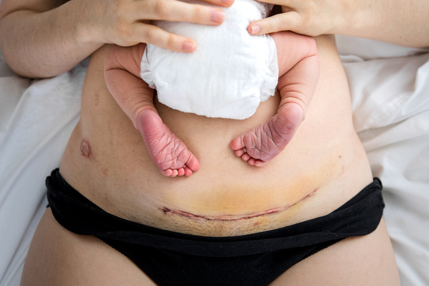 birth photographer, columbus, ga, atlanta, postpartum, csection scar, cesarean, skin to skin-10