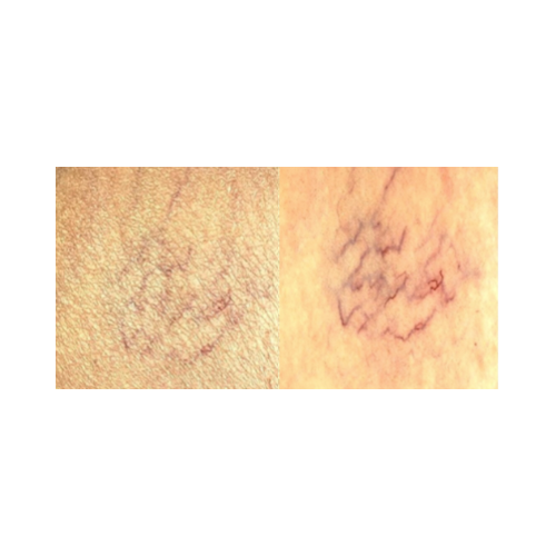 Subsurface skin features visible with Syris polarized light system