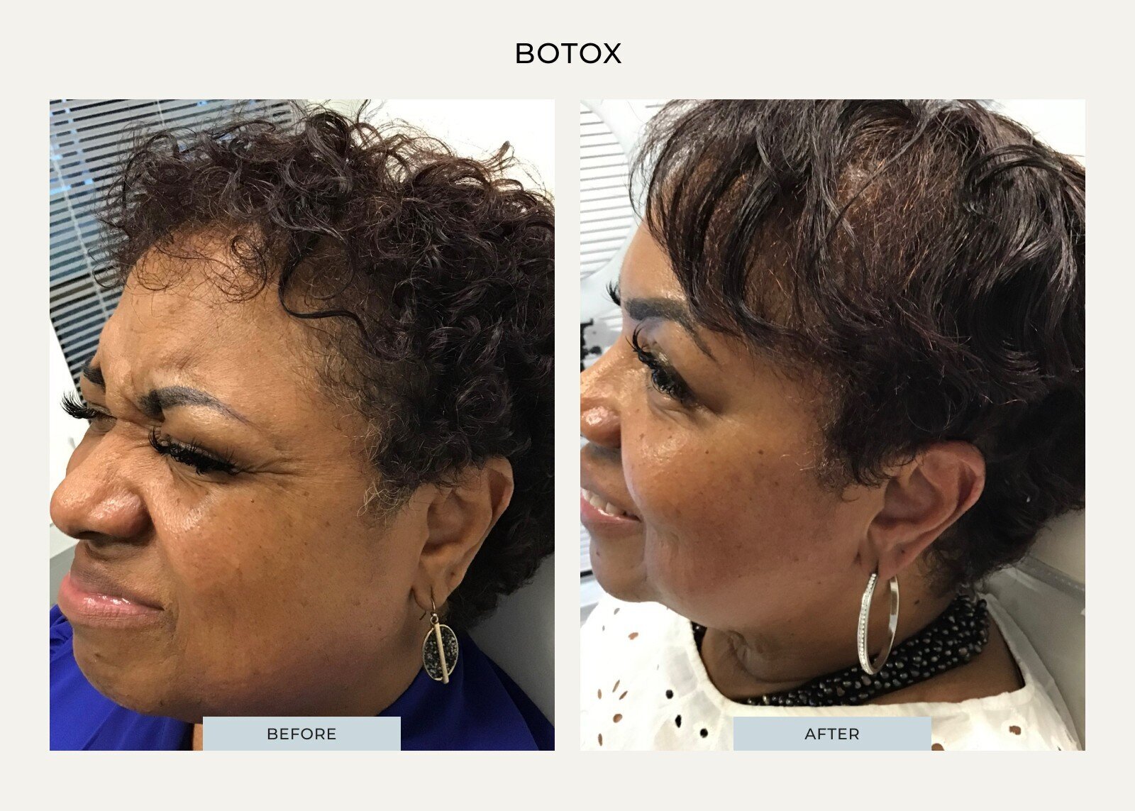 beauty-by-kd-client7-botox