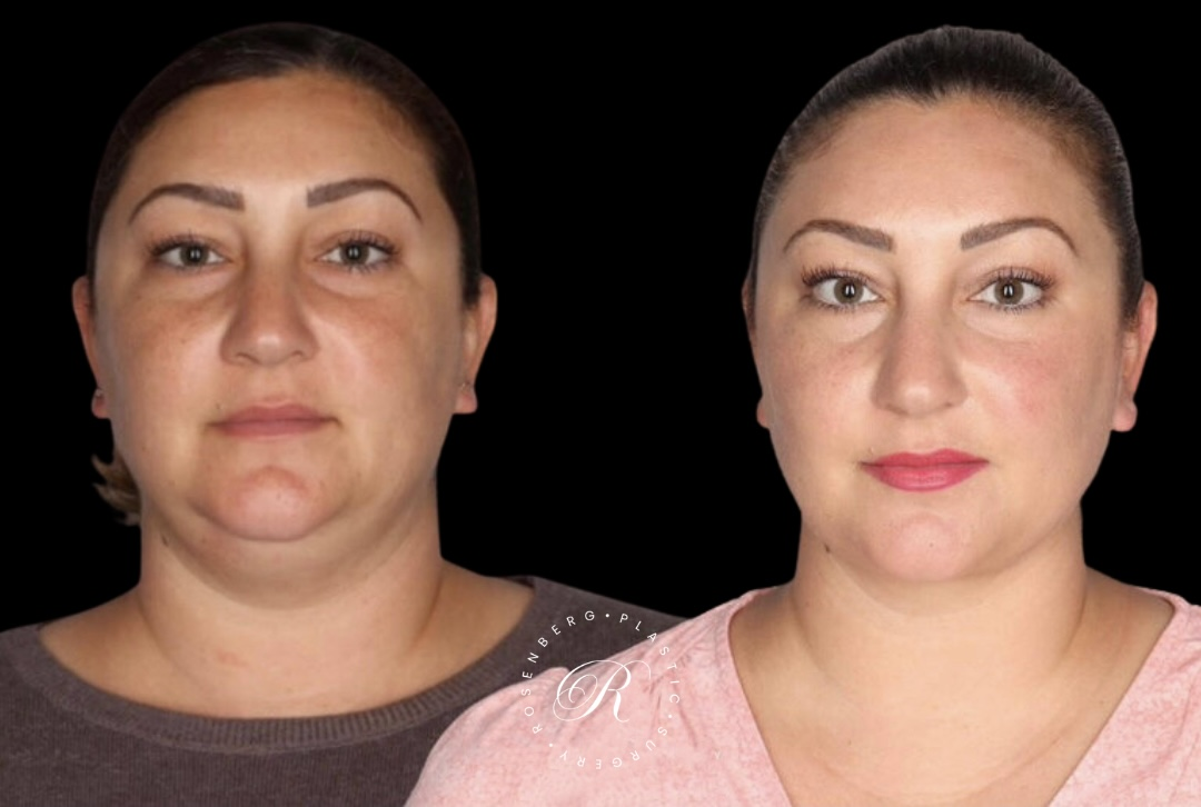Neck Lipo RPS Before & After.zip - 25