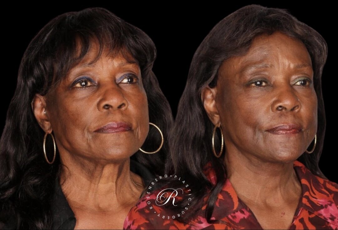 Facelift RPS Before & After.zip - 7