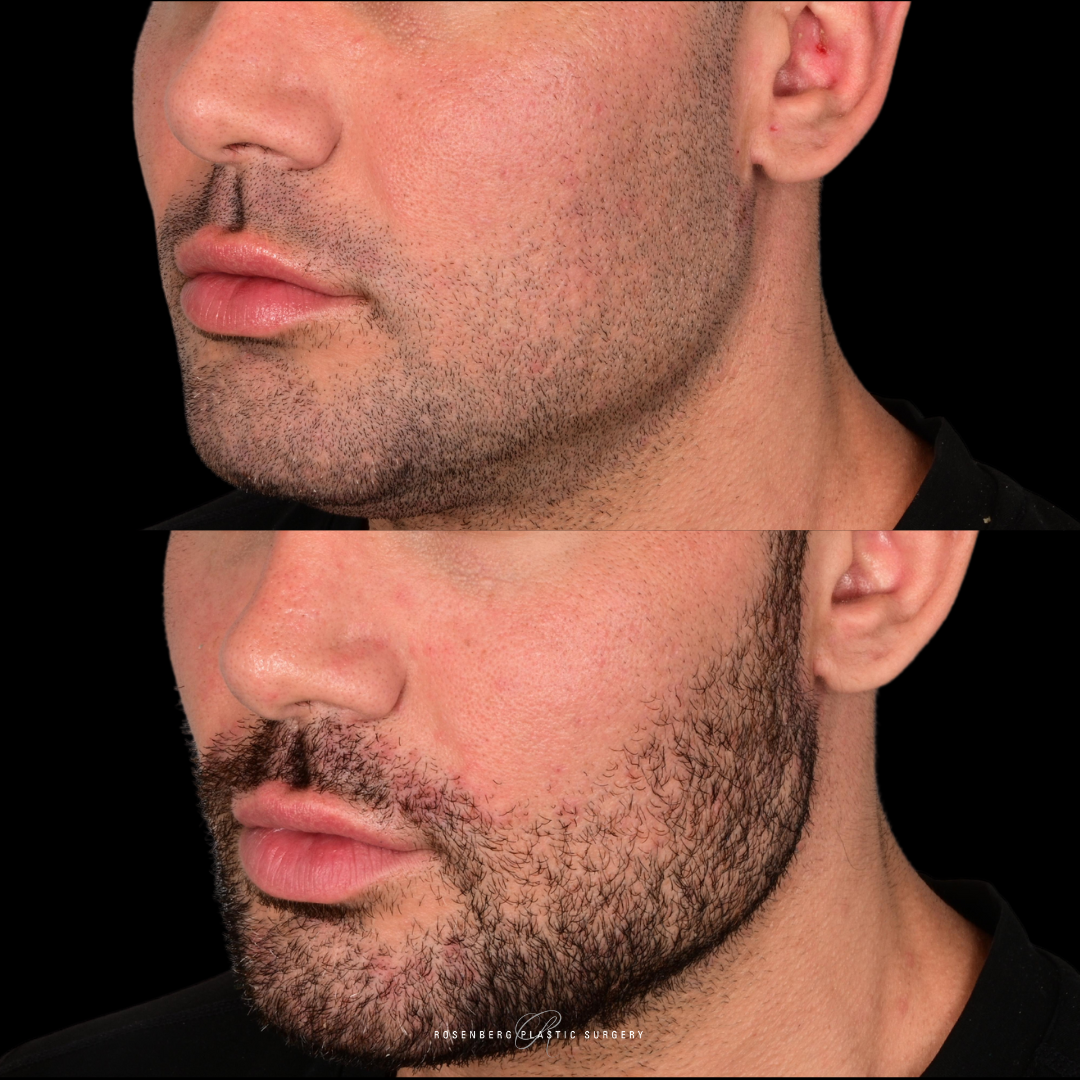 Template for Rosenberg Plastic Surgery B&A-9